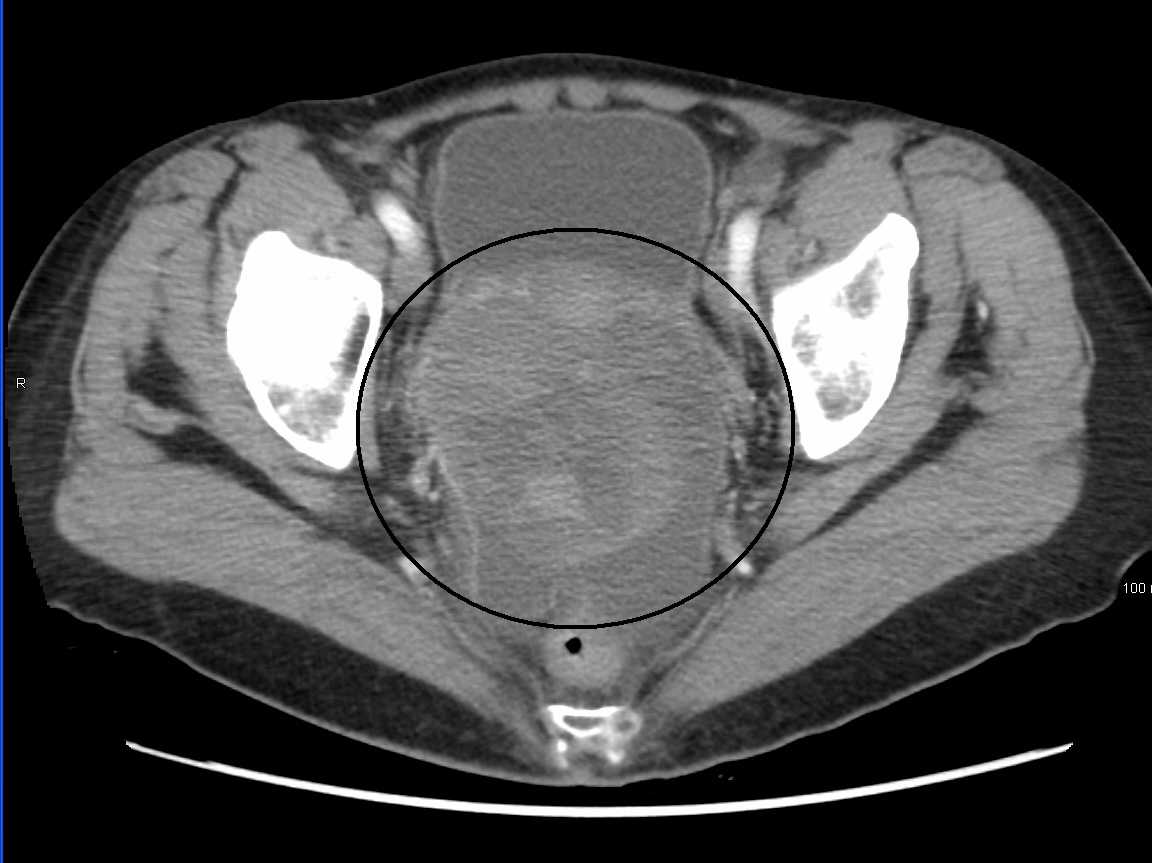 Ovarian cancer imaging techniques.