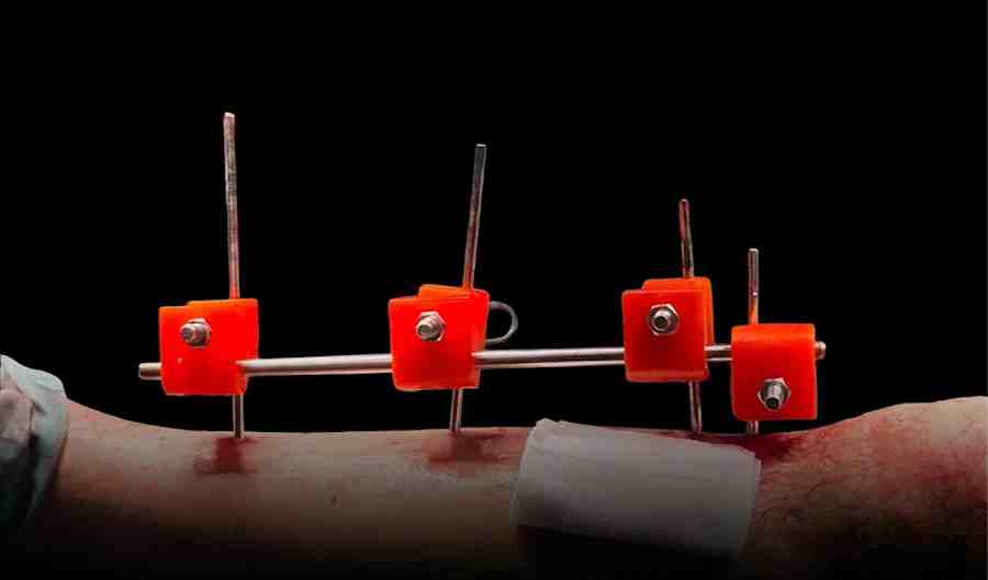 3D fixators are assembled from printed plastic parts, and used to treat complex fractures.(Credit: Al Jazeera)