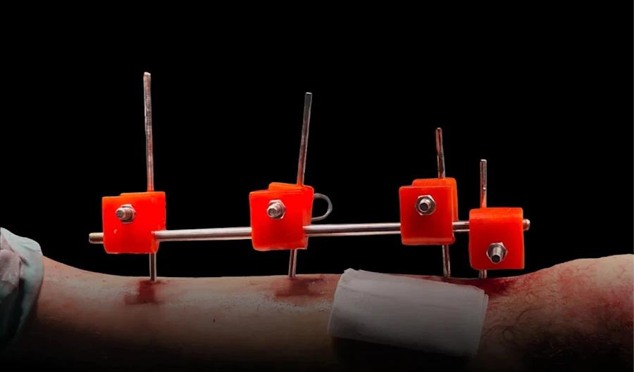 تُجمَّع أجهزة التثبيت الثلاثية الأبعاد من قطع بلاستيكية مطبوعة وتُستخدم لعلاج الكسور المعقدة. (المصدر: الجزيرة) تُجمَّع أجهزة التثبيت الثلاثية الأبعاد من قطع بلاستيكية مطبوعة وتُستخدم لعلاج الكسور المعقدة. (المصدر: الجزيرة)